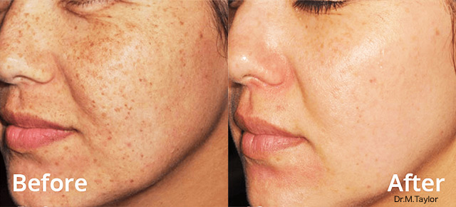 Before / After picture of hyperpigmentation treatment on woman with LUMECCA