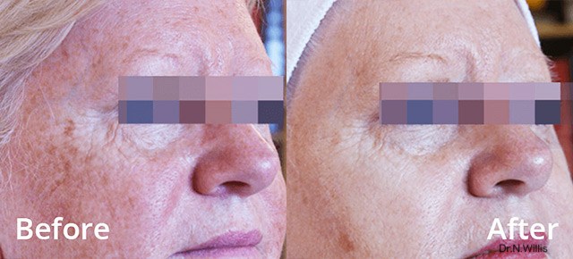Before / After picture of hyperpigmentation treatment on elderly with LUMECCA