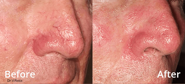 Before / After picture of telangiectasis treatment on man with LUMECCA