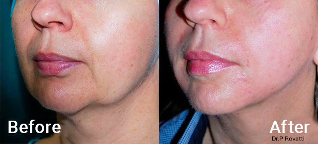 Before / After picture jawline treatment with Morpheus8